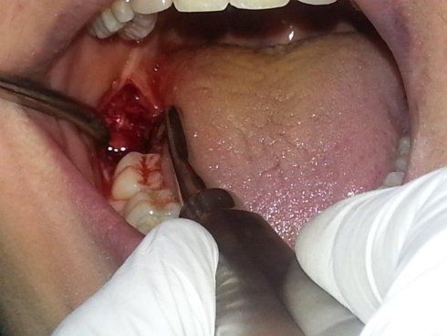 Chirurgia denti