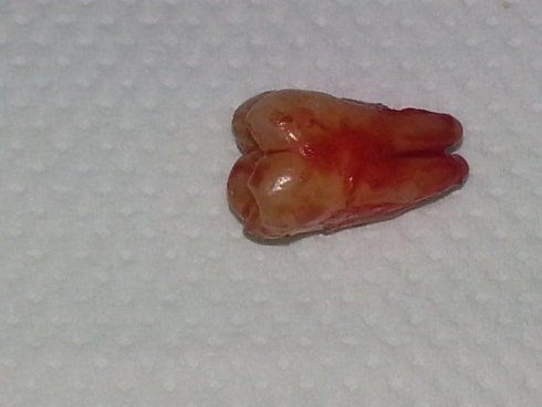 Rimozione denti