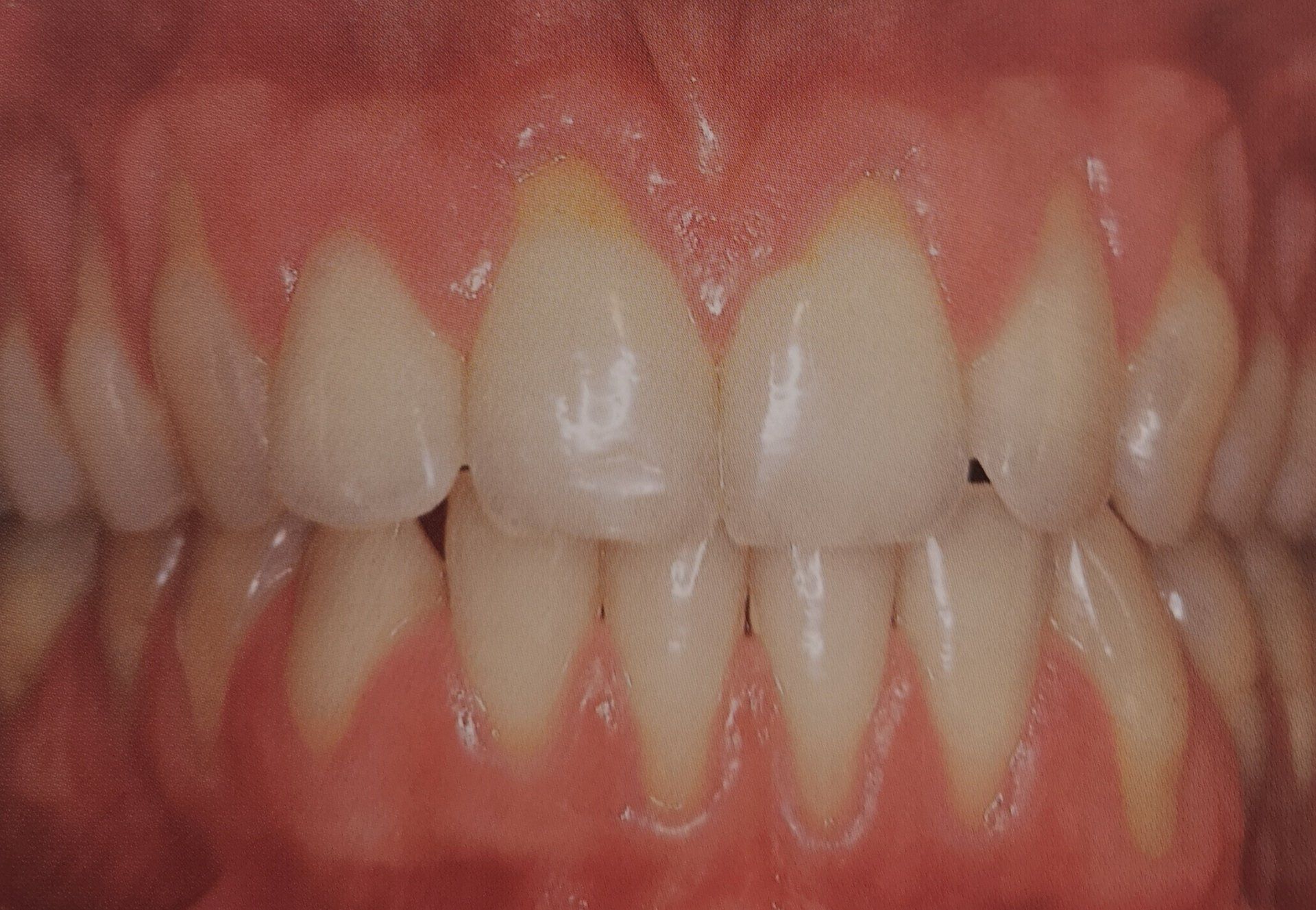 Primo piano di denti, giallastri, con gengive rosa. Alcuni denti presentano una leggera decolorazione vicino al bordo gengivale.