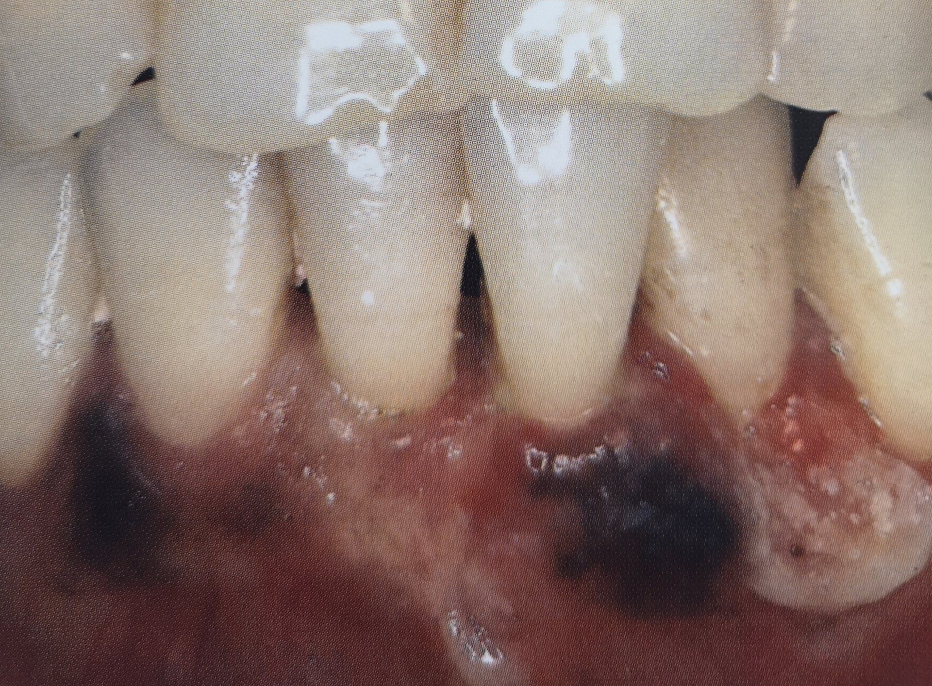 Primo piano di denti e gengive infiammate con una vasta area scura e scolorita vicino ai denti inferiori, probabilmente una crescita o una lesione.