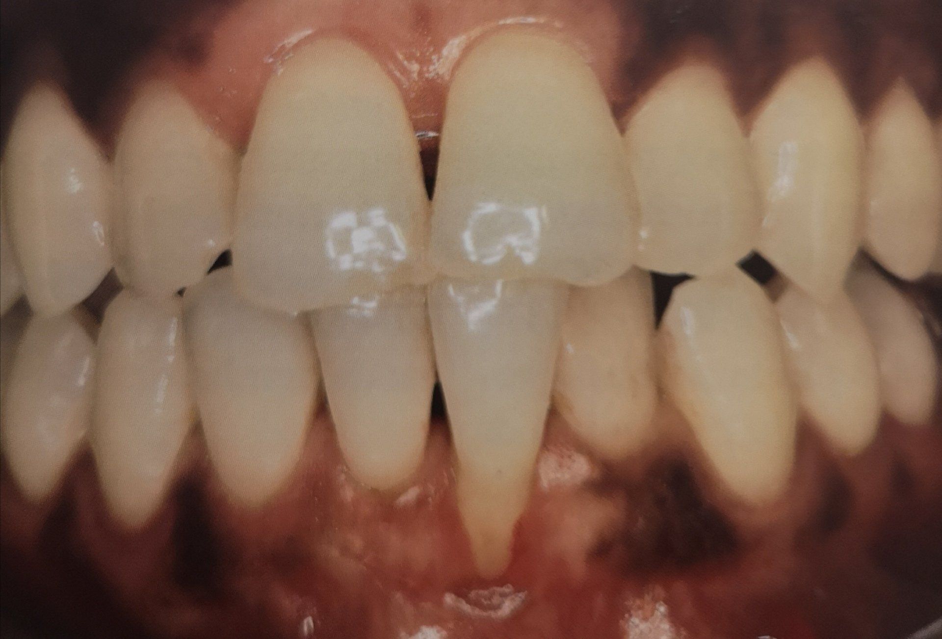 Primo piano di denti umani, di colore leggermente biancastro. Il dente centrale è lungo e appuntito.