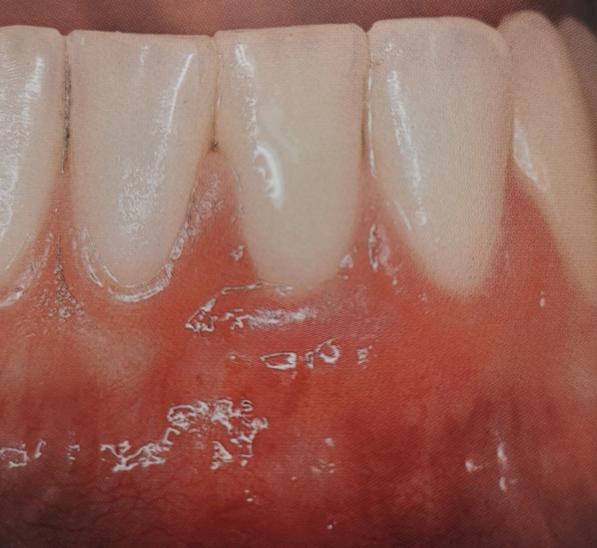 Primo piano dei denti e delle gengive infiammate e rossastre.