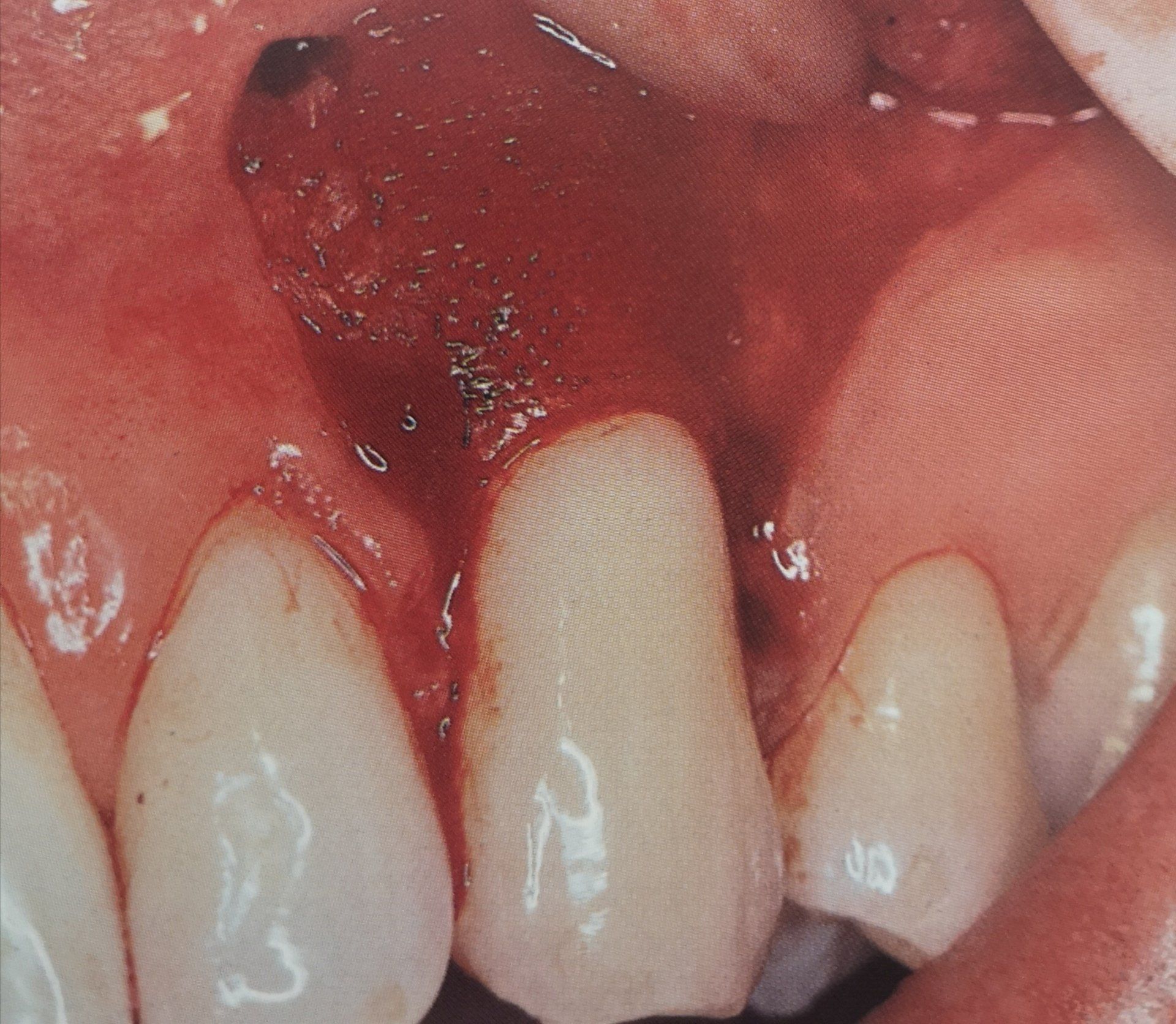 Le gengive attorno ai denti sono sanguinanti e sanguinanti, con una zona scura e danneggiata vicino al centro.