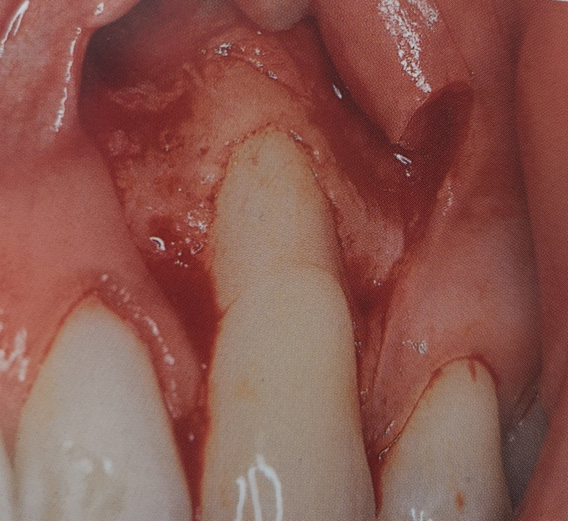Immagine chirurgica della bocca di un paziente. Un dente è esposto, con tessuto gengivale e osso visibili, a indicare un intervento odontoiatrico.