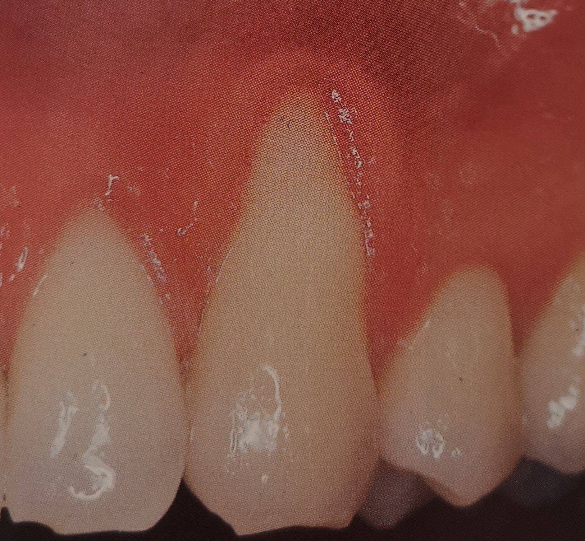 Primo piano di denti e gengive umane. Un dente centrale appare più chiaro degli altri, incastonato nelle gengive rosse.