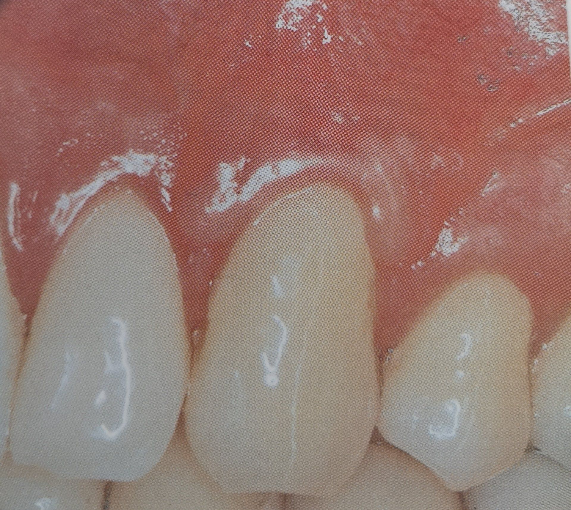 Primo piano di denti e gengive; sono visibili due incisivi centrali con una linea gengivale leggermente infiammata.