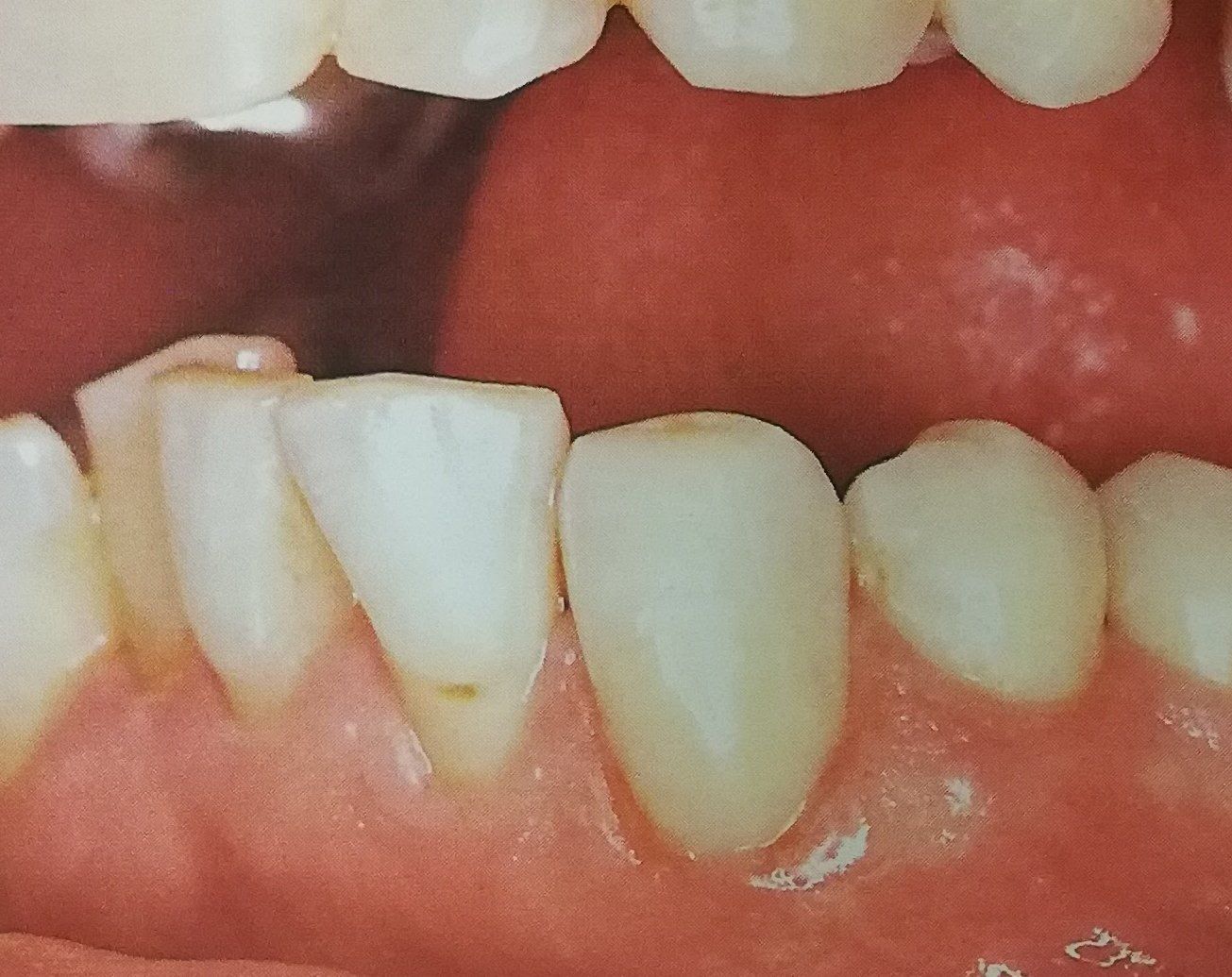 Primo piano della bocca di una persona che mostra denti danneggiati e scheggiati. È visibile il bordo gengivale.