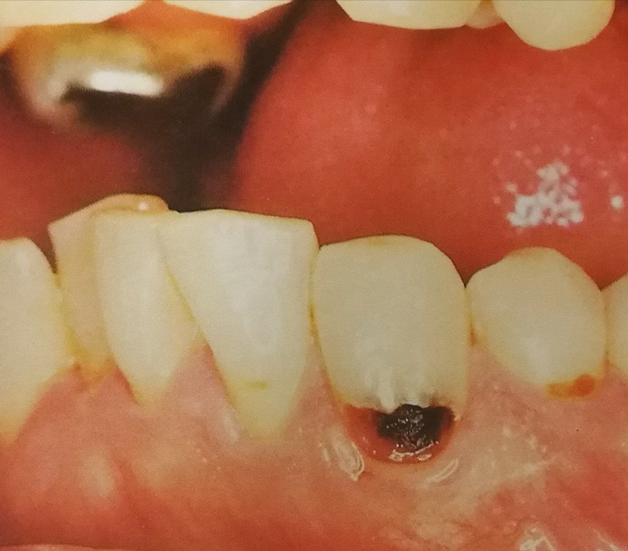 Primo piano dei denti; un dente presenta una cavità scura vicino al bordo gengivale, segno di carie.