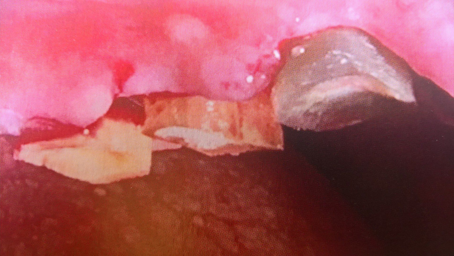 Primo piano della bocca; frammenti di denti scheggiati sulle gengive, con tessuto orale rosa visibile.