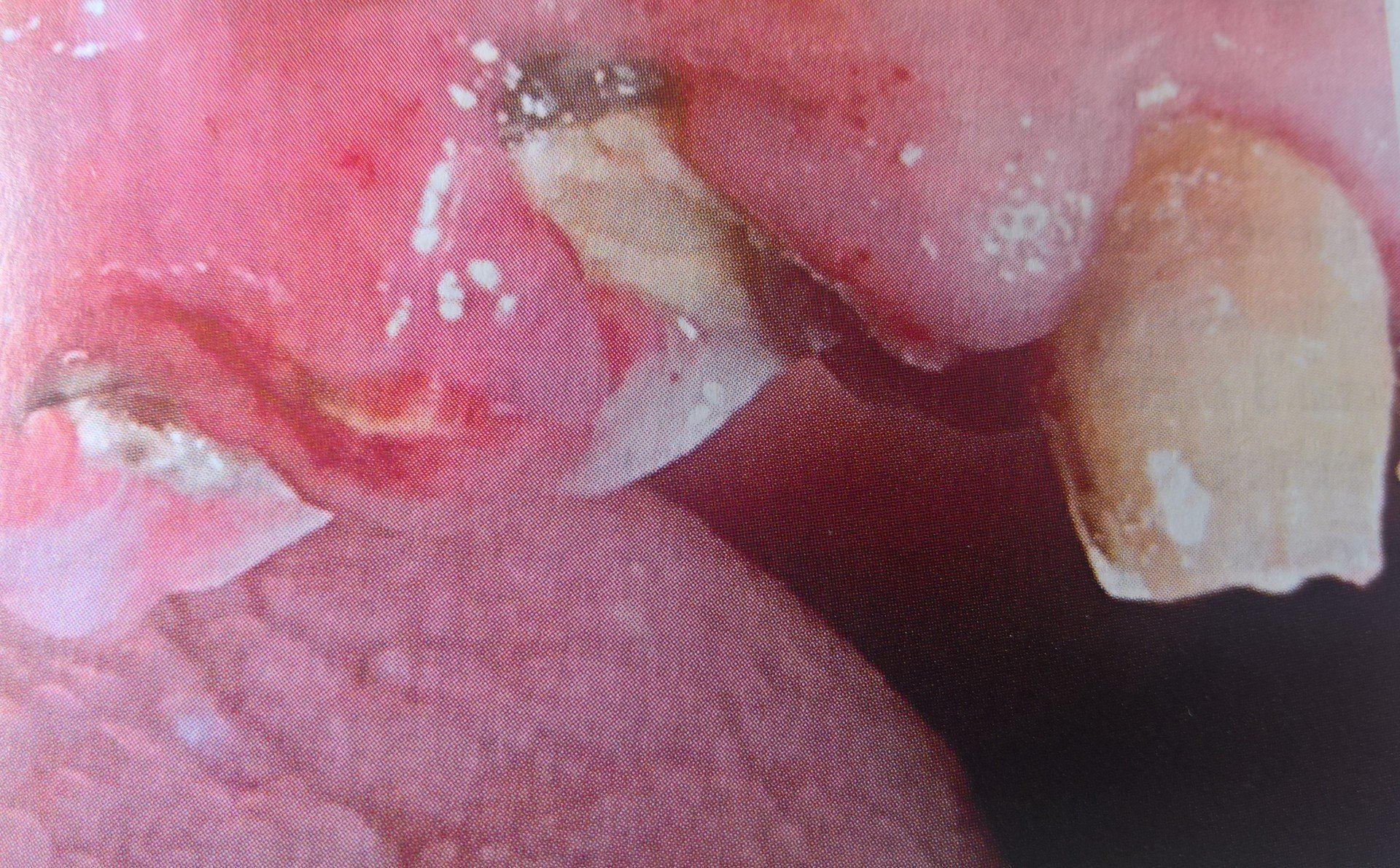Primo piano di una bocca con denti danneggiati e gengive infiammate; alcuni denti sono scheggiati e scoloriti.