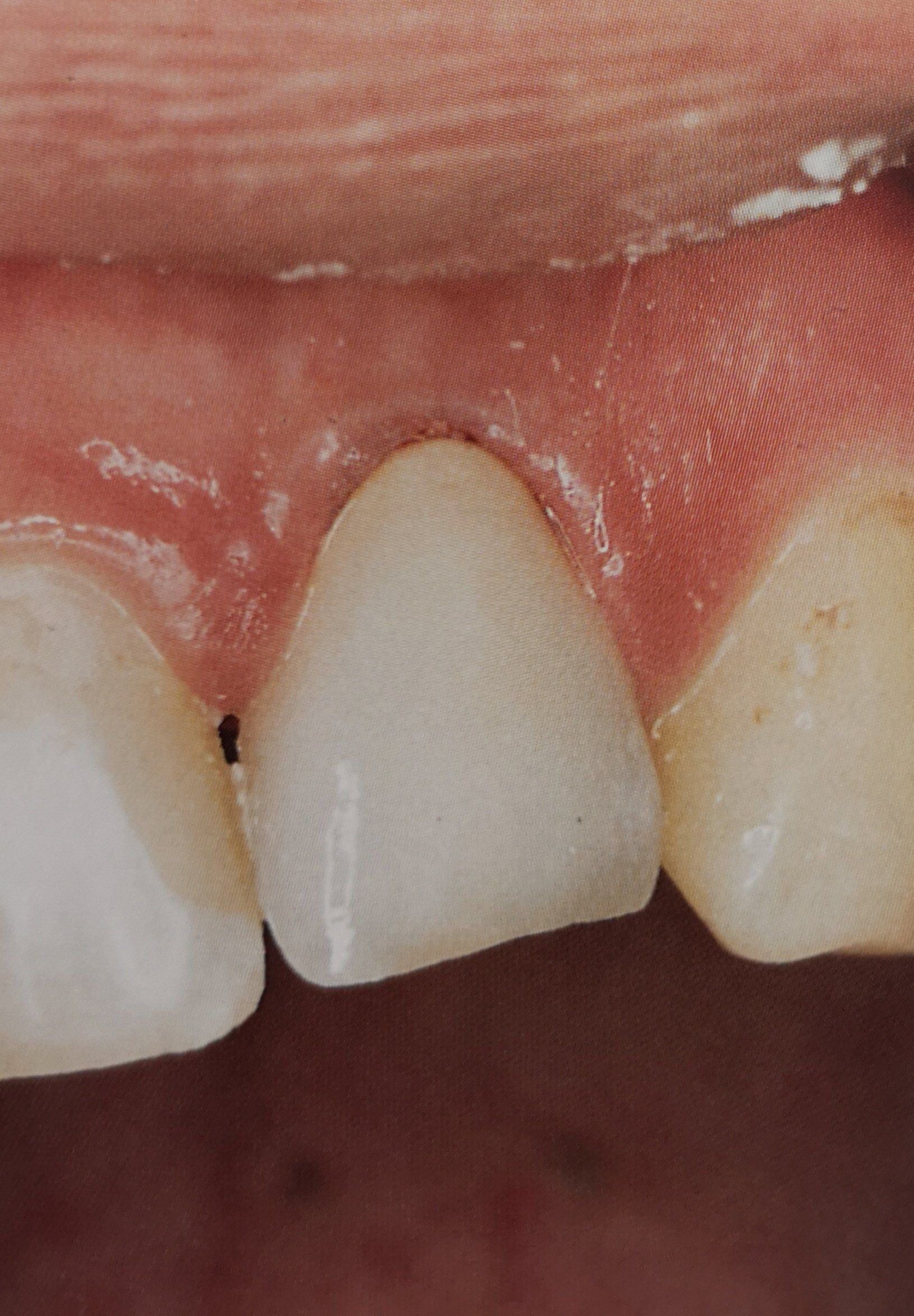 Primo piano della bocca di una persona; una corona dentale sul dente anteriore con gengive rosa visibili.