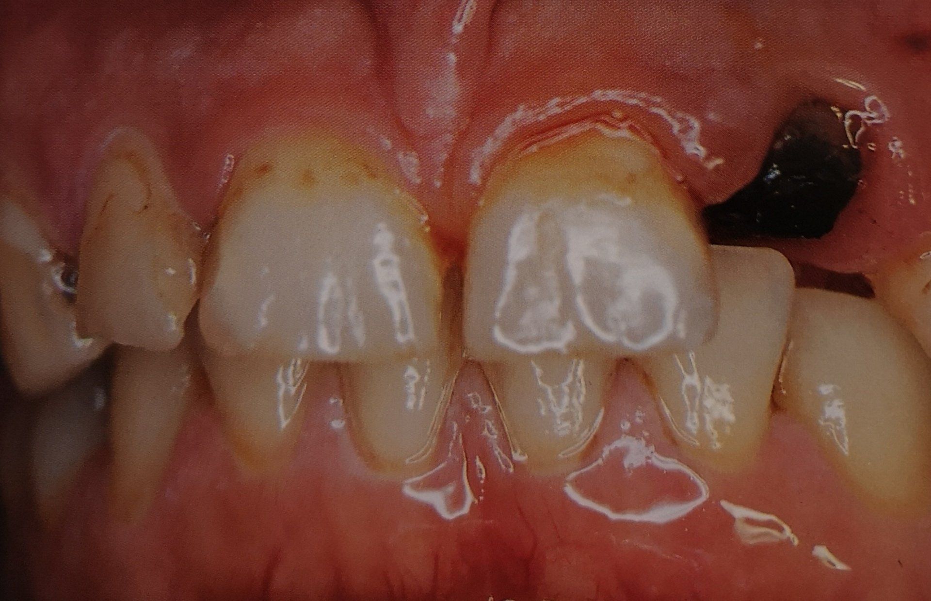 Primo piano dei denti, che mostrano macchie ingiallite e una macchia scura sul lato destro.