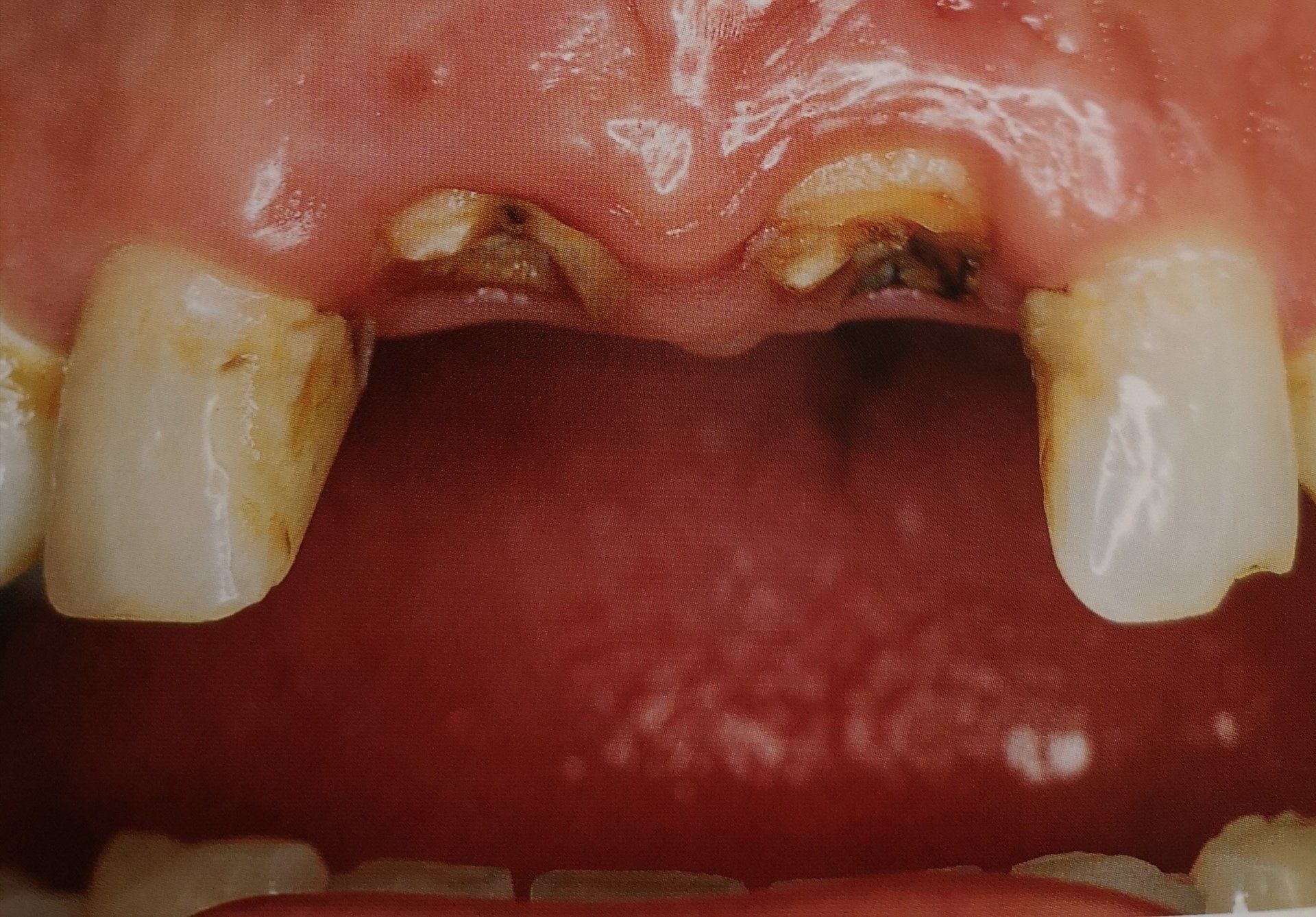 Bocca con denti mancanti; gengive e denti marci; denti ingialliti; bocca aperta; gengive rosse visibili.