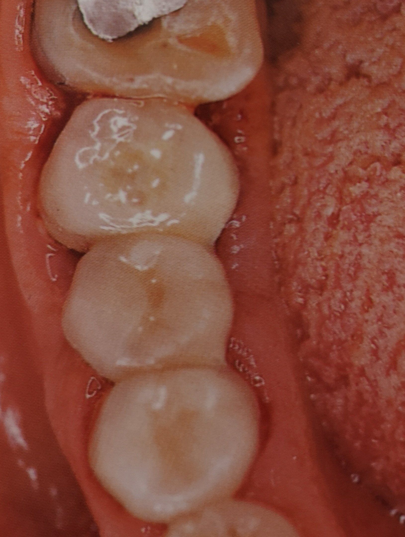 Primo piano dei denti inferiori di una persona. Sono visibili diversi molari, lucidi e sani. Le gengive rosa circondano i denti.