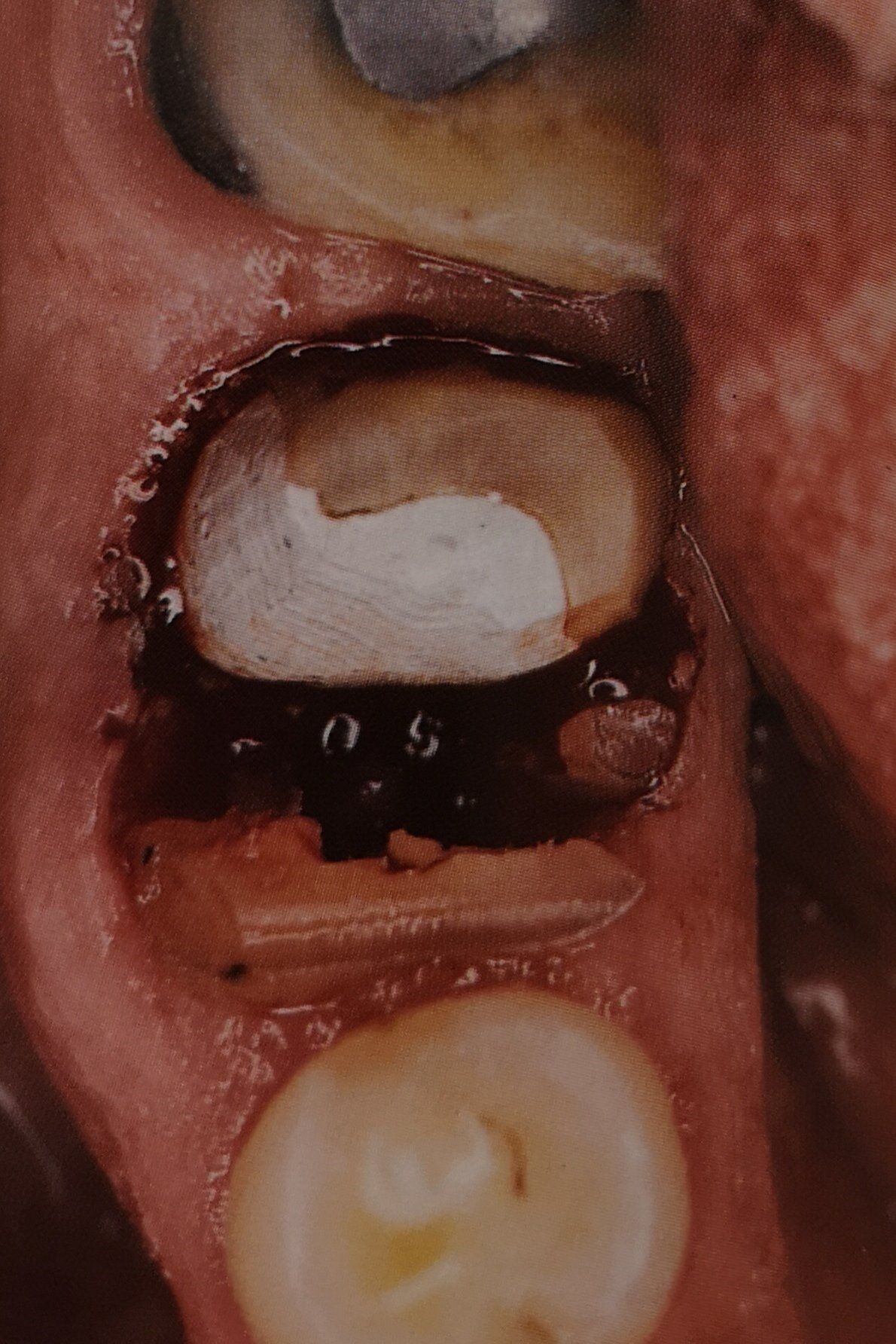 Alveolo dentale aperto con liquido scuro, una sostanza bianca e una radice del dente esposta.