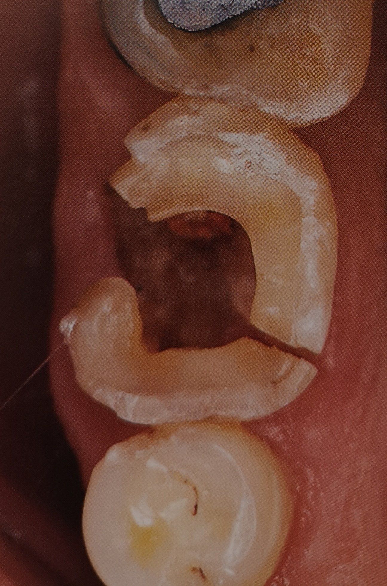 Primo piano di un molare gravemente fratturato, che mostra un grosso pezzo di dente mancante, probabilmente a causa di carie o trauma.