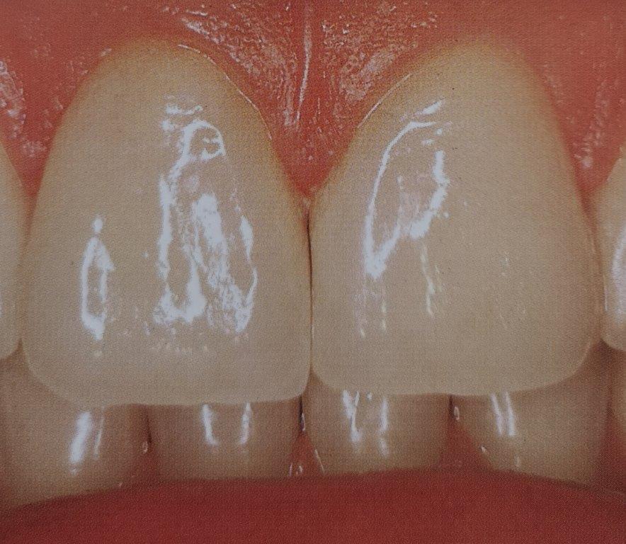 Primo piano di due denti anteriori sani e bianchi, con superfici lisce e lucide, contro le gengive rosa.