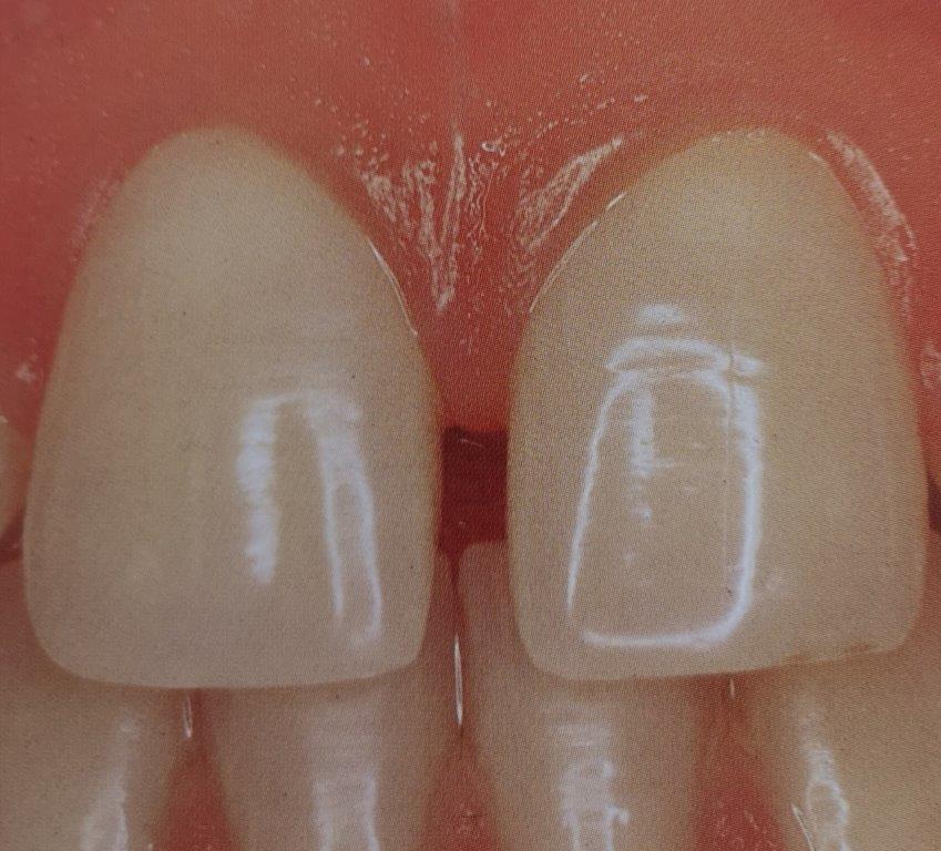 Primo piano di due denti anteriori superiori; bianco perla con un leggero spazio, gengive visibili.