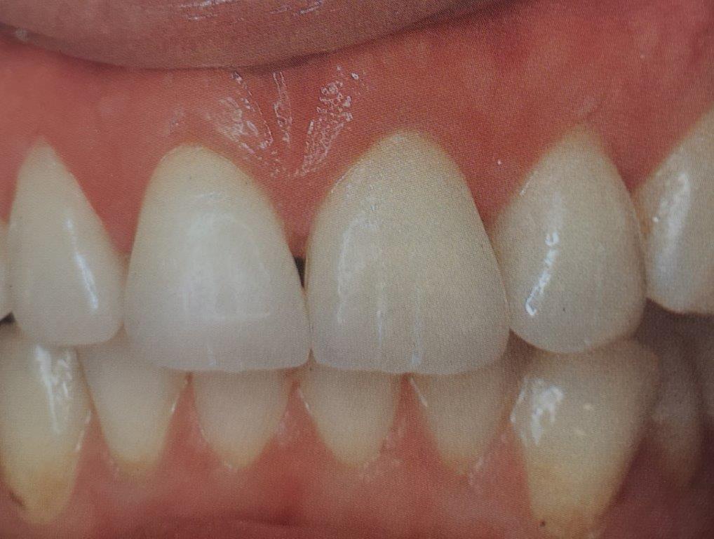 Primo piano di denti umani sani. I denti sono bianchi e hanno una forma naturale, visibile in bocca.