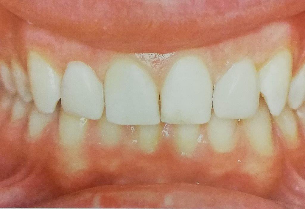 Primo piano di denti umani sani. I denti anteriori sono bianchi, gli altri di un colore leggermente giallastro.