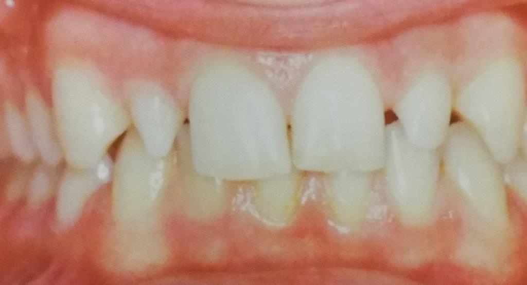 Vista ravvicinata dei denti che mostrano un leggero affollamento, un colore giallastro e gengive visibili.