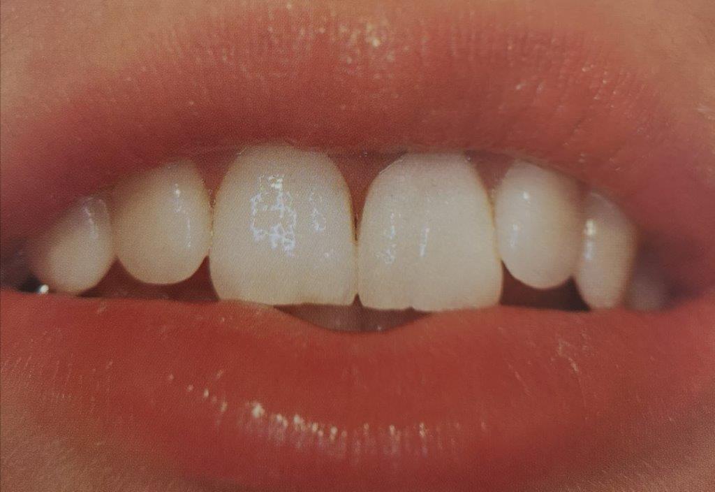 Primo piano della bocca di una persona che mostra denti bianchi e labbra rosa e lucide.