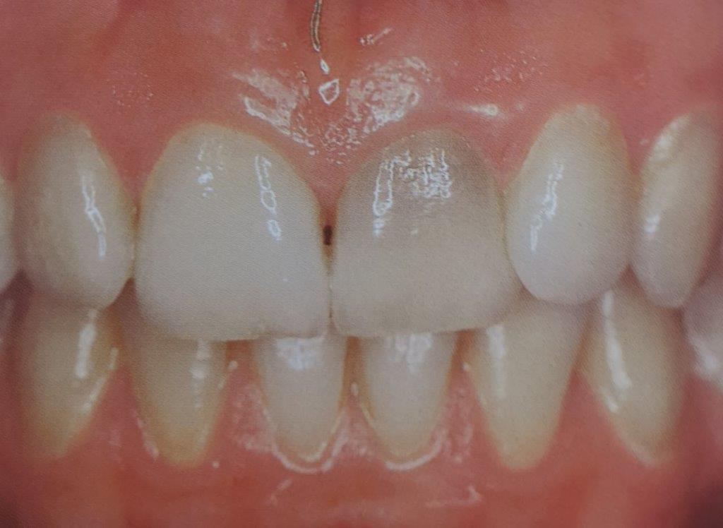 Primo piano dei denti, in cui si vede un dente anteriore scolorito, circondato da denti bianchi e sani e gengive rosa.