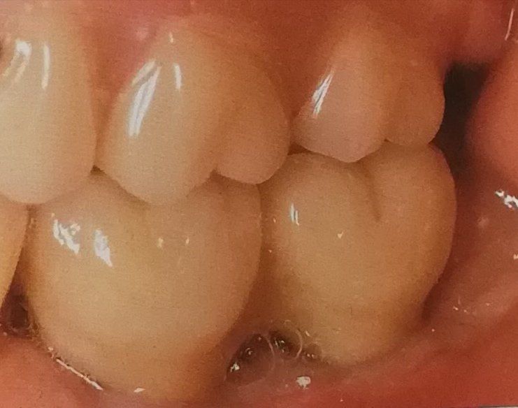 Primo piano dei denti umani, che mostrano i molari con superfici masticatorie visibili e un po' di saliva.
