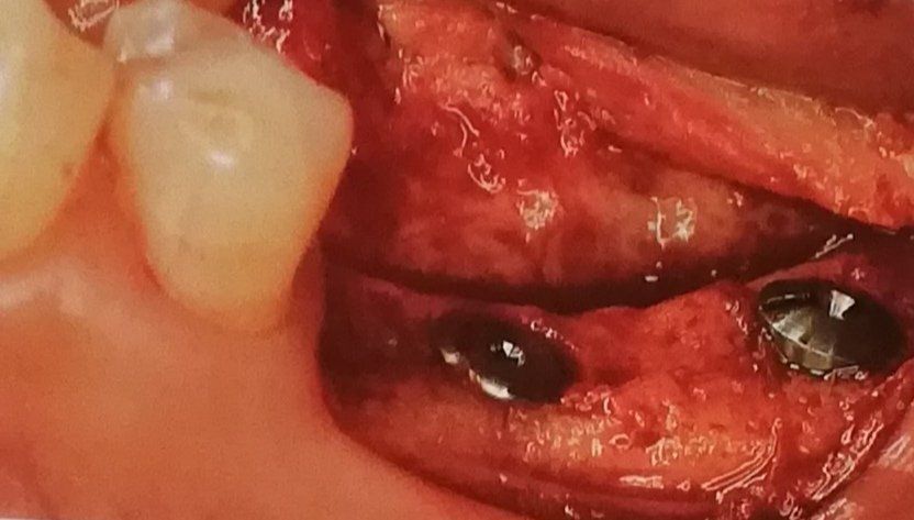 Impianti dentali Dentista Paola Daniela Lomardi