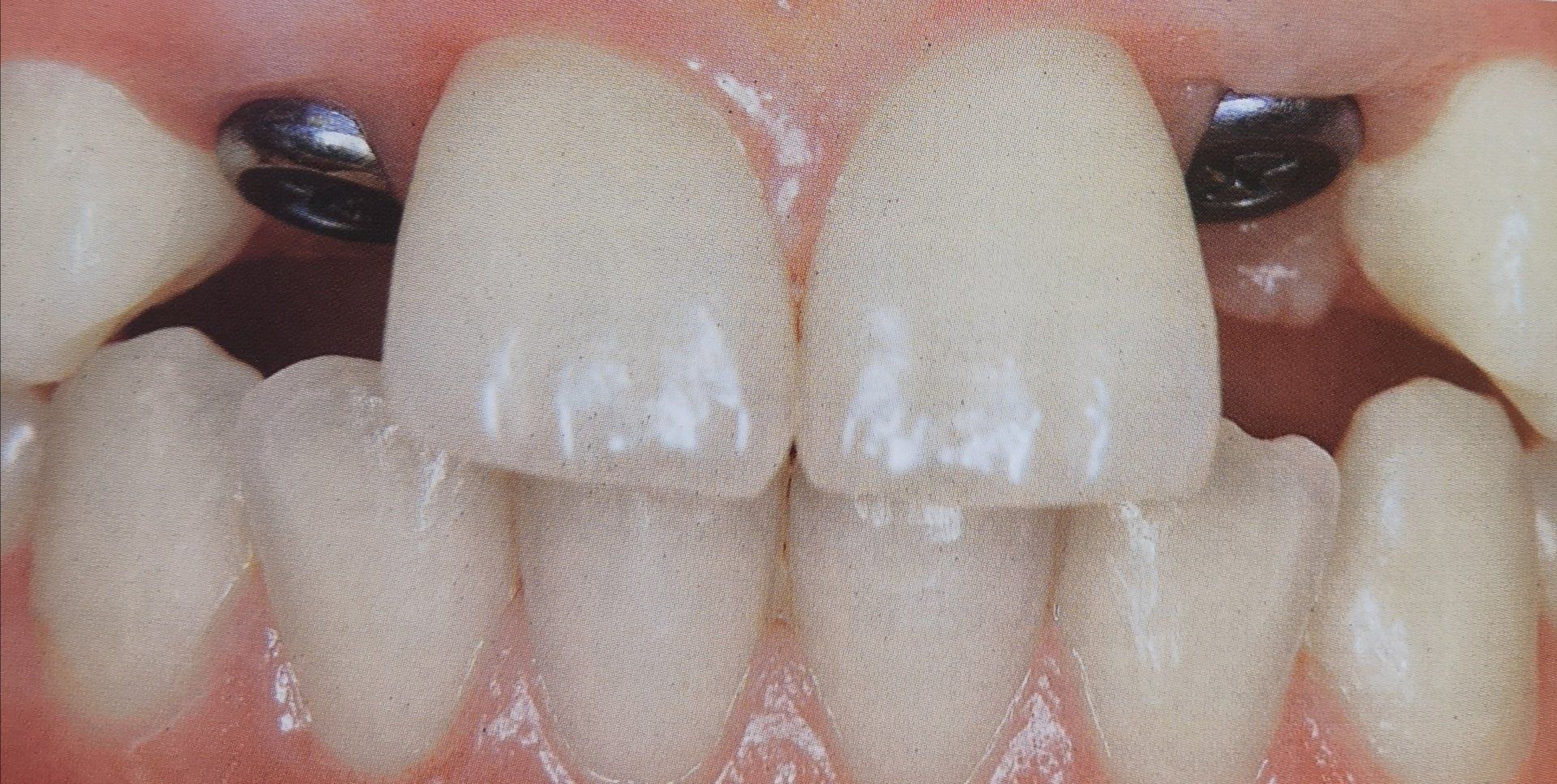 Primo piano dei denti con interventi odontoiatrici, comprese corone e attacchi metallici.