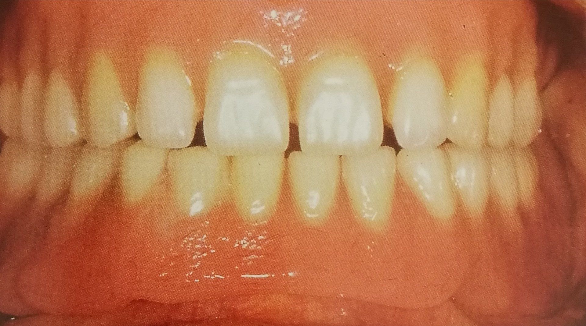 Primo piano dei denti di una persona, che mostrano una leggera tonalità giallastra, gengive visibili e un allineamento centrato.