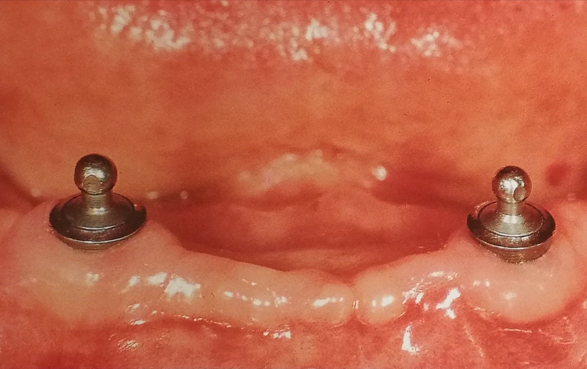 Primo piano di due impianti dentali che sporgono dalle gengive, preparati per le protesi dentarie.