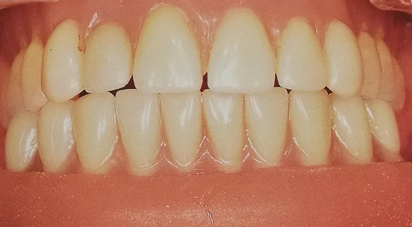 Primo piano dei denti di una persona, bianchi e dritti, con una leggera sfumatura gialla.