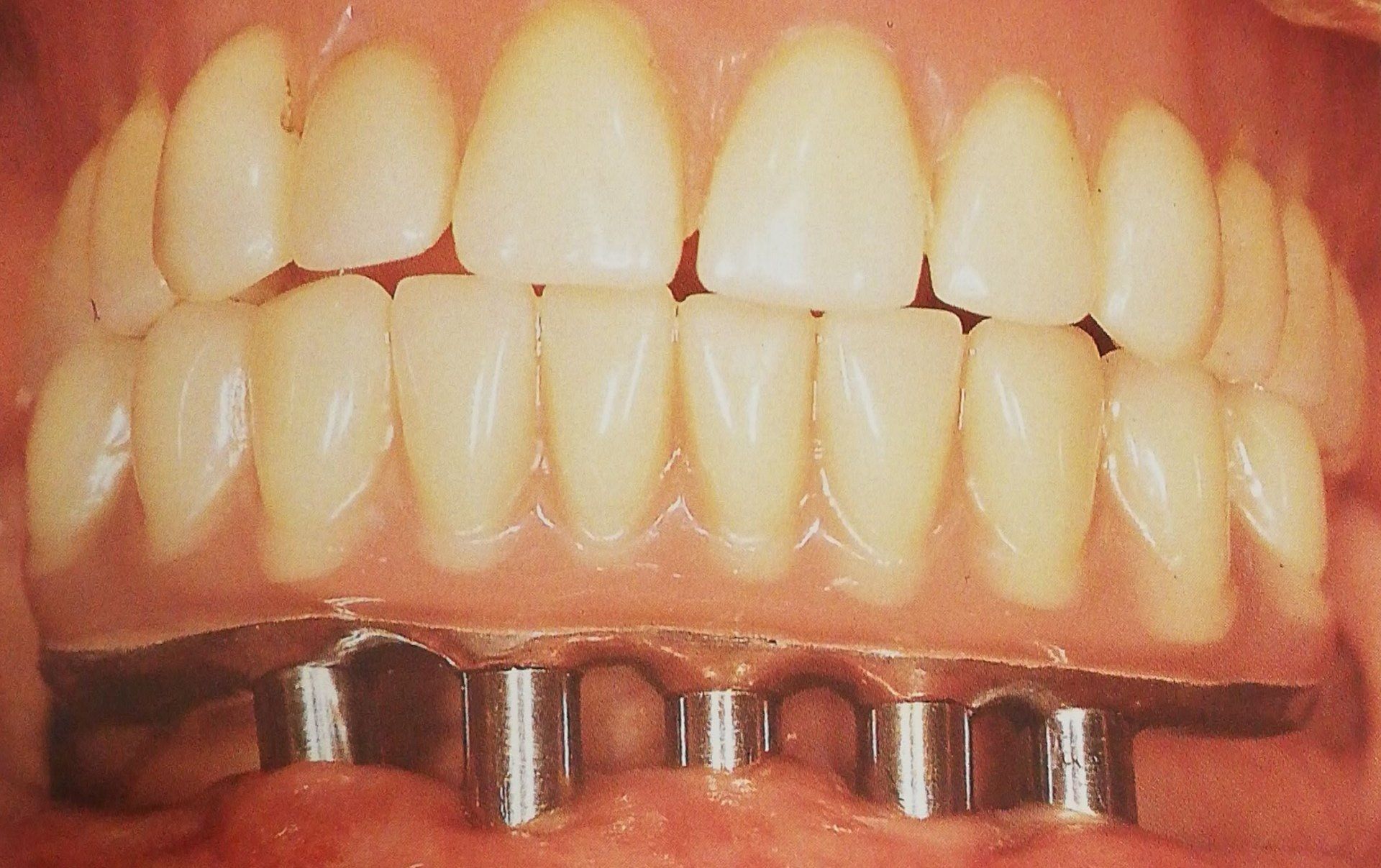Vista ravvicinata di una serie completa di protesi dentarie superiori fissate agli impianti dentali nella mascella inferiore.