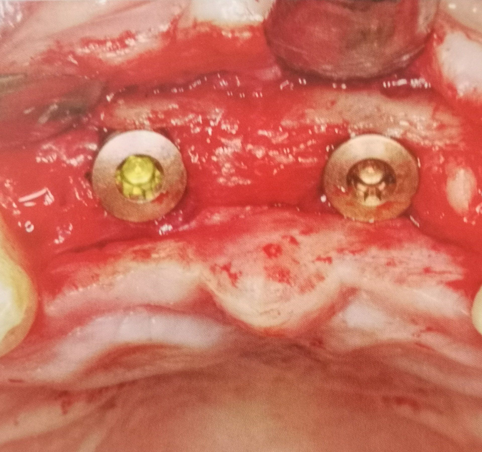 Due impianti dentali fissati nella mascella superiore, circondati da tessuto rosso e sangue.