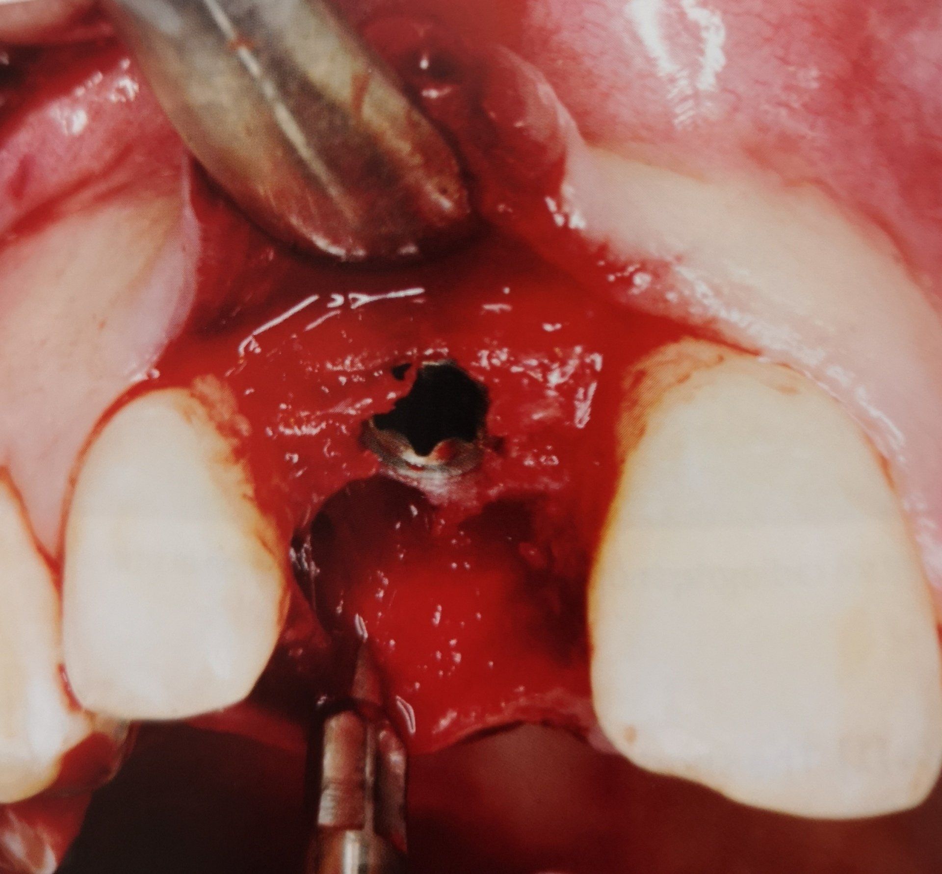 Intervento chirurgico dentale: osso esposto con impianto, sanguinante, circondato da denti e strumenti.