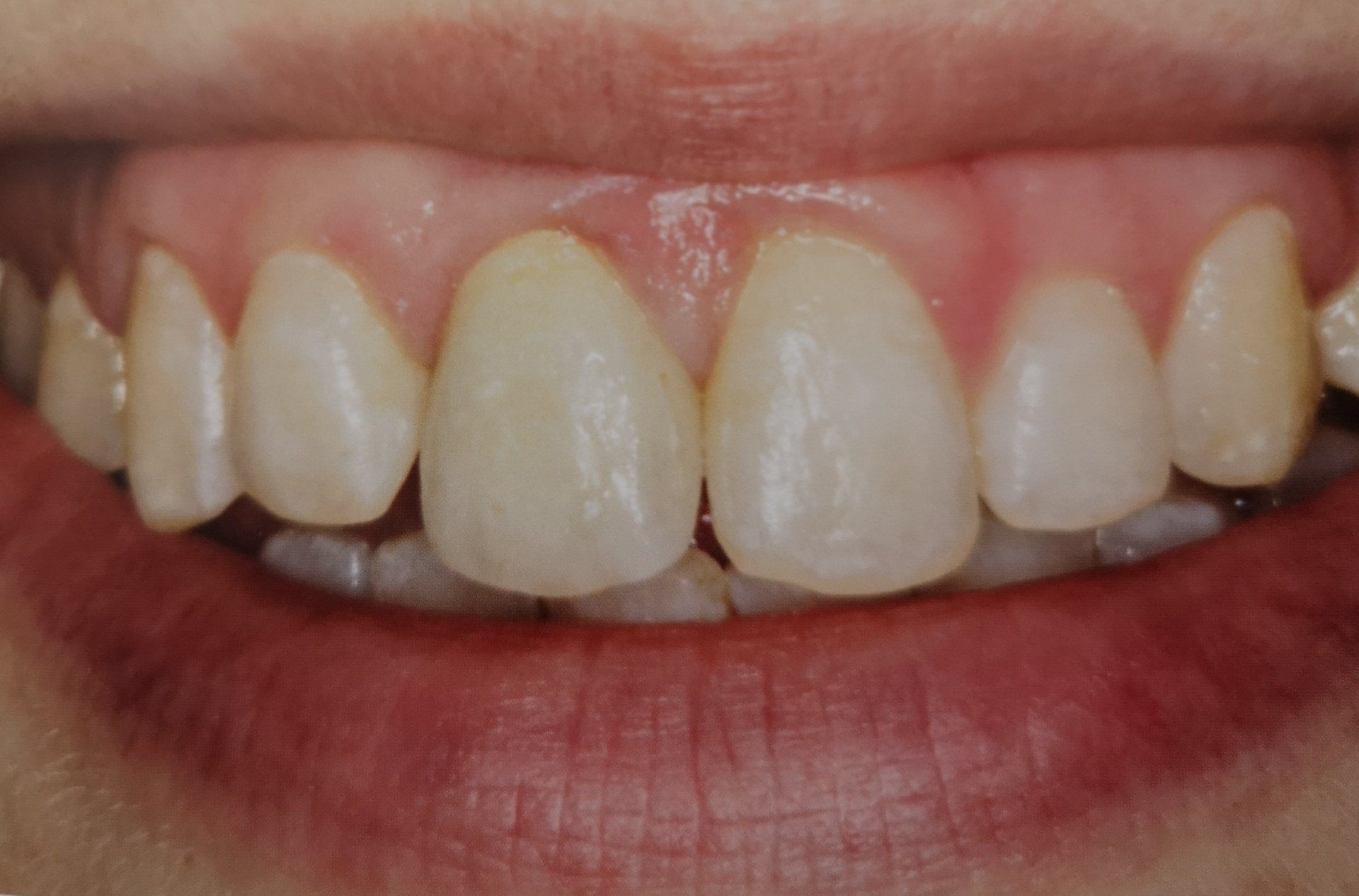 Primo piano dei denti e delle gengive di una persona, che mostra denti leggermente irregolari e di colore chiaro, e gengive rosa.