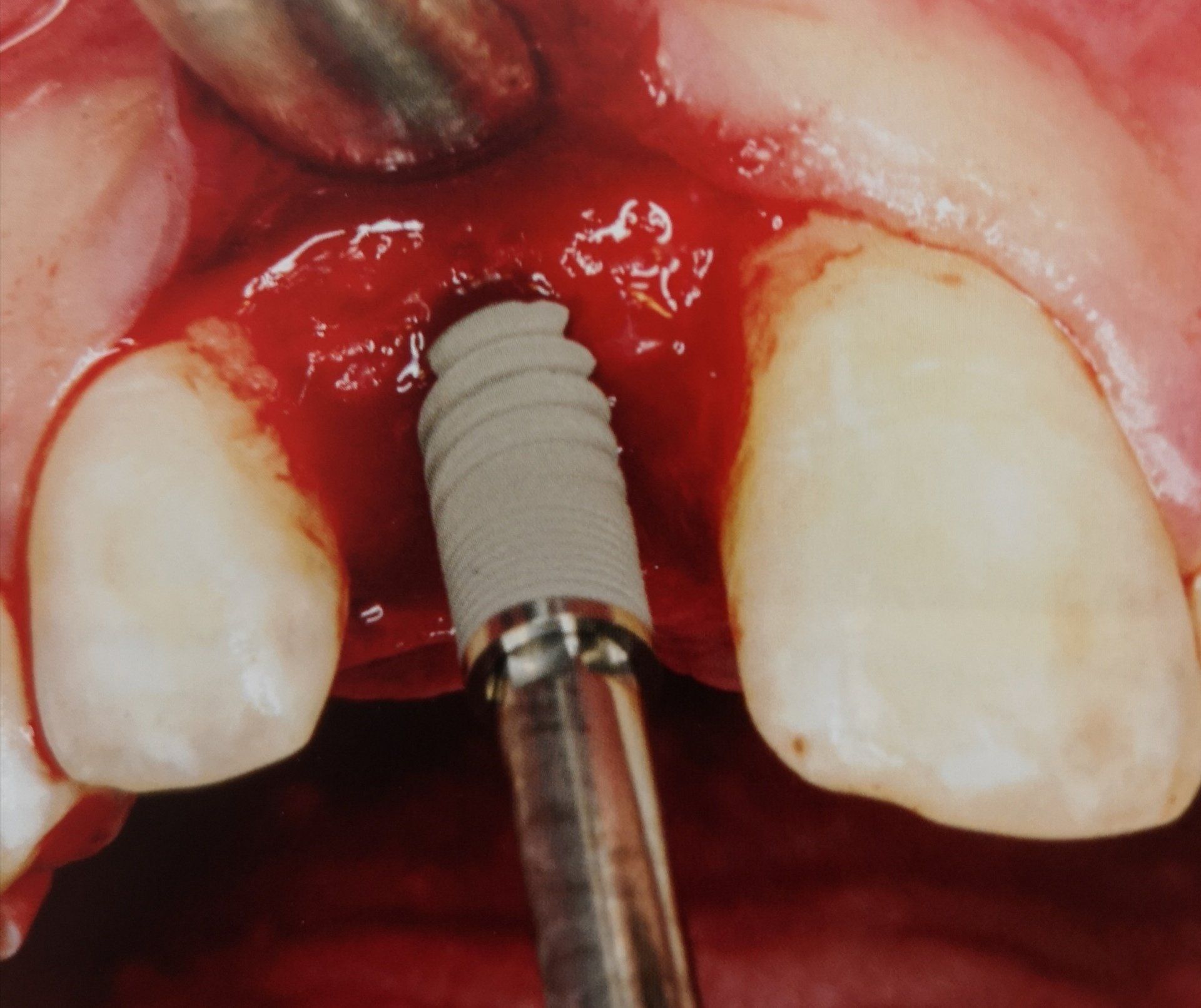 Impianto dentale inserito nella gengiva superiore, tra due denti anteriori, mediante strumenti chirurgici.