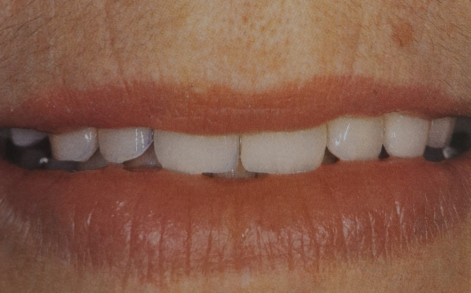 Primo piano del sorriso di una persona che rivela i denti. Alcuni denti sono mancanti o rotti; le labbra sono rossastre.
