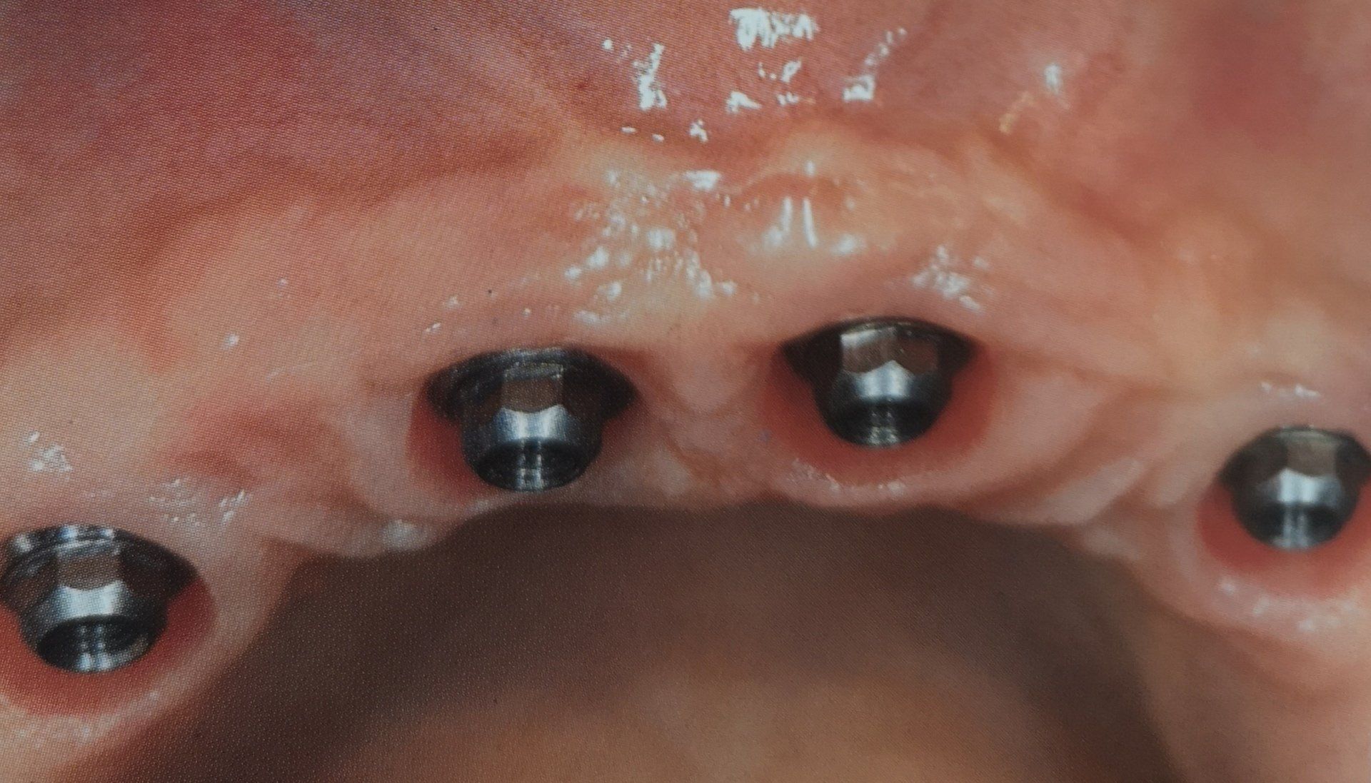 Primo piano degli impianti dentali nella mascella superiore; gli impianti sono in argento e inseriti nelle gengive.