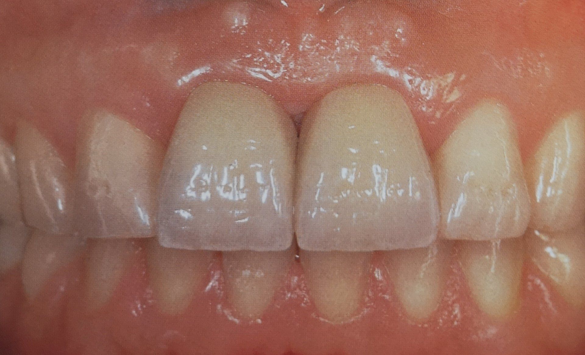 Primo piano di due incisivi centrali con leggere linee orizzontali, circondati da gengive e altri denti.