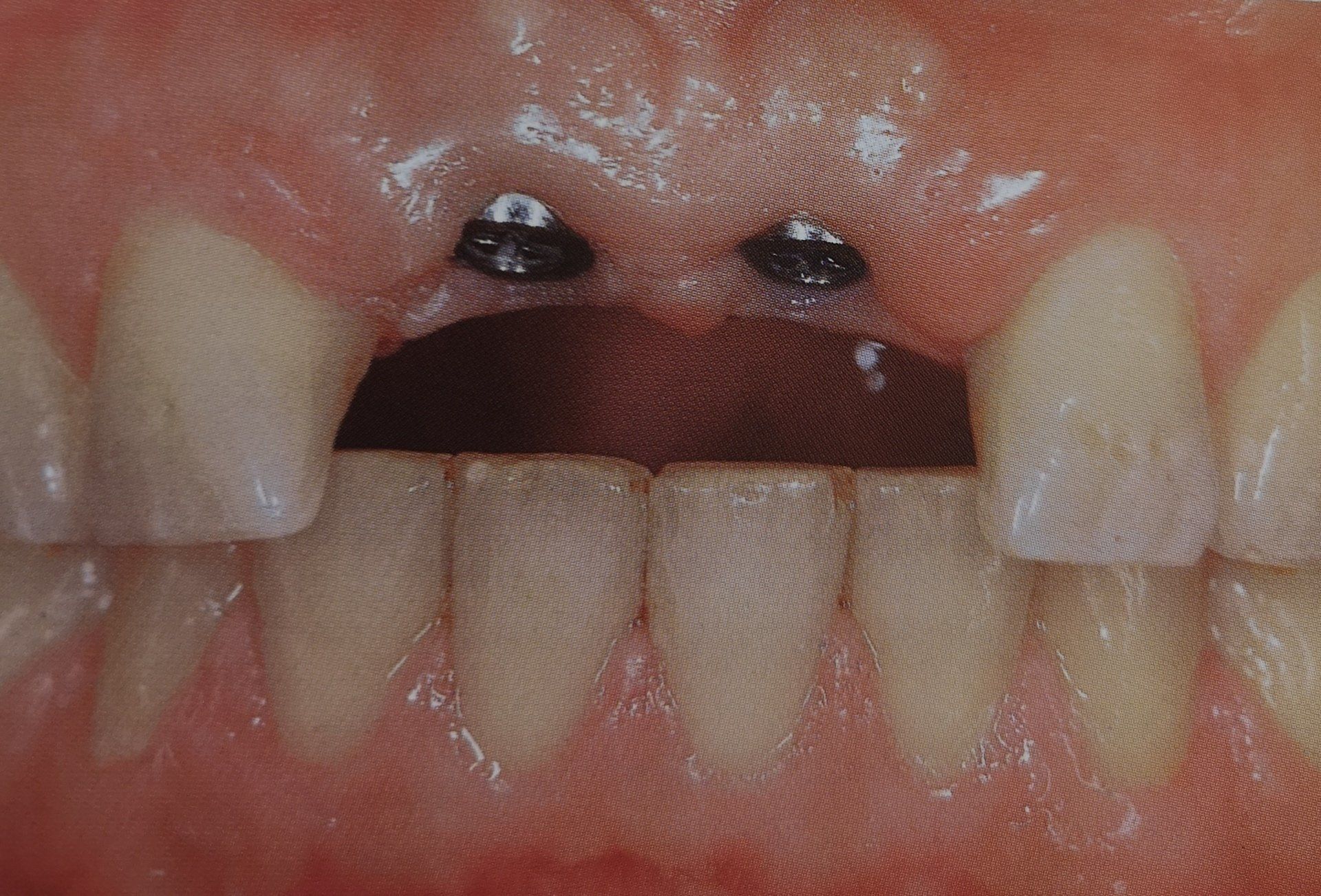 Vista dentale che mostra due impianti metallici nella gengiva superiore, dove mancano i denti.