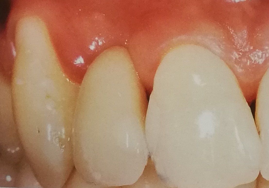 Primo piano dei denti con gengive infiammate e rosse; i denti sono di un bianco perlaceo.