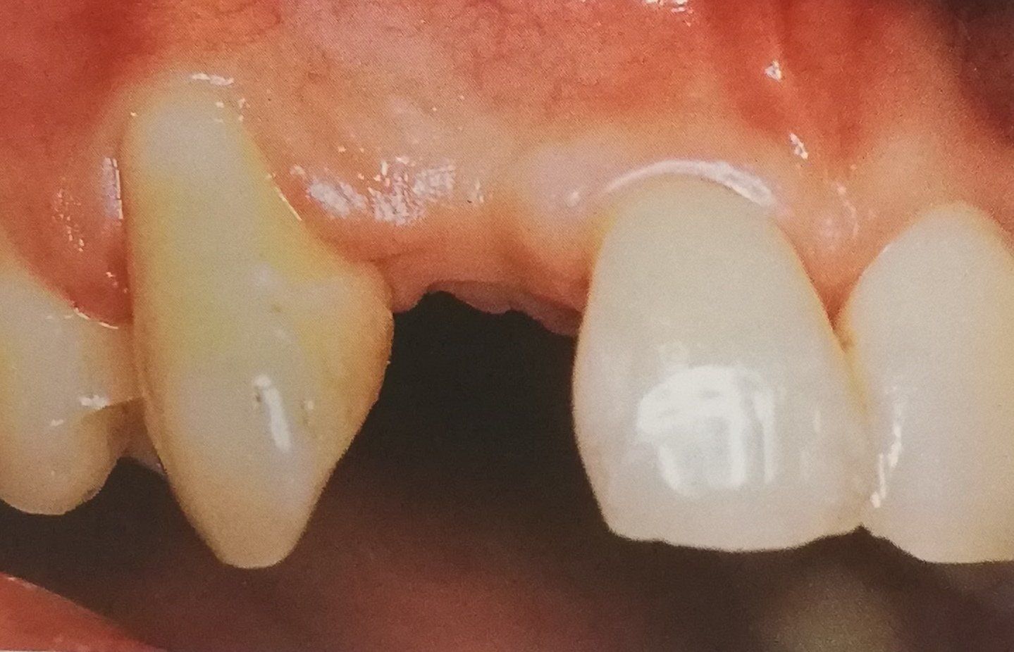 Primo piano dei denti. Un dente è scheggiato, il dente adiacente è intero e intatto, con un'otturazione bianca lungo il bordo gengivale.