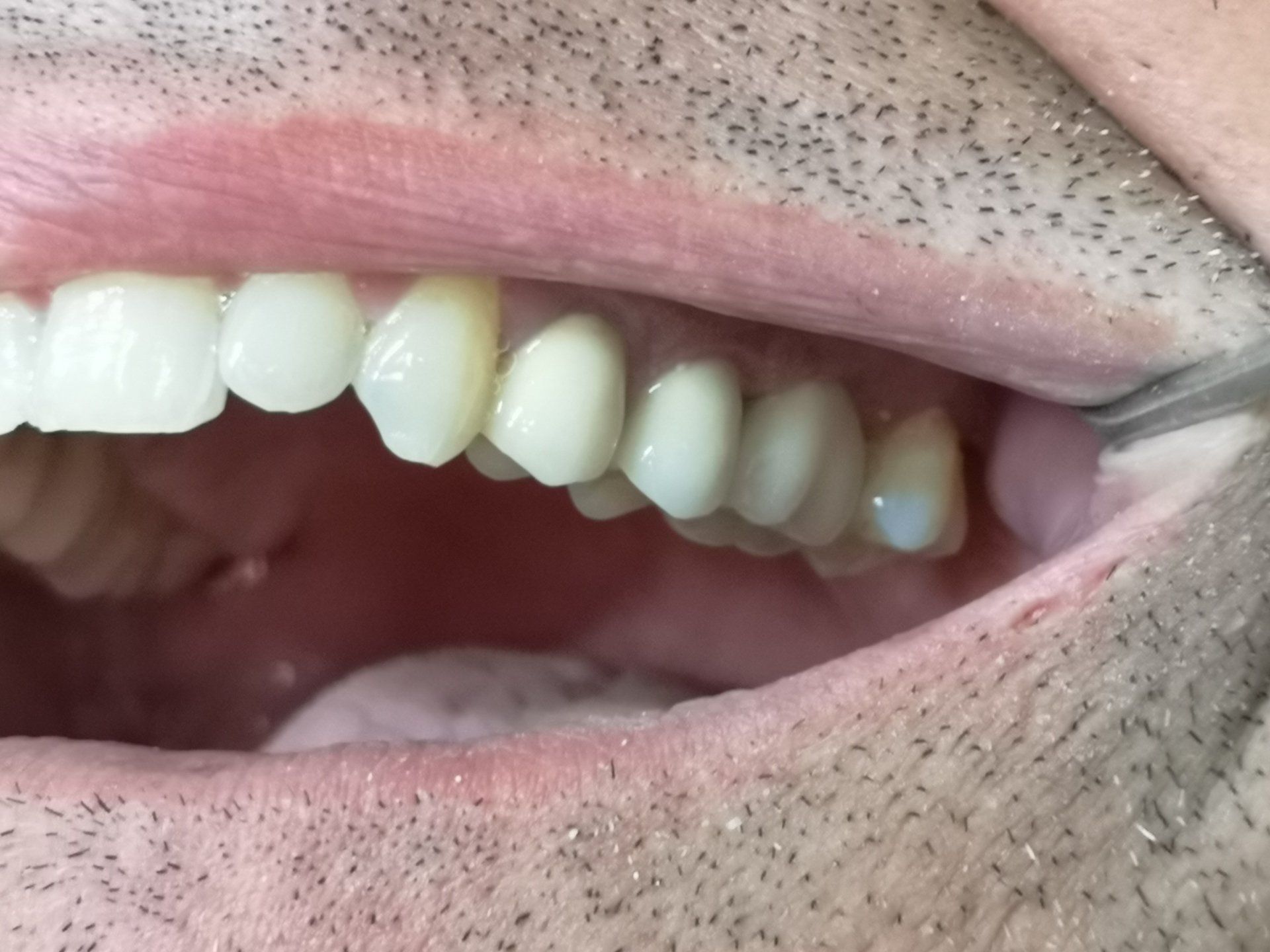 Primo piano della bocca di una persona con visibili diverse corone dentali bianche e brillanti.