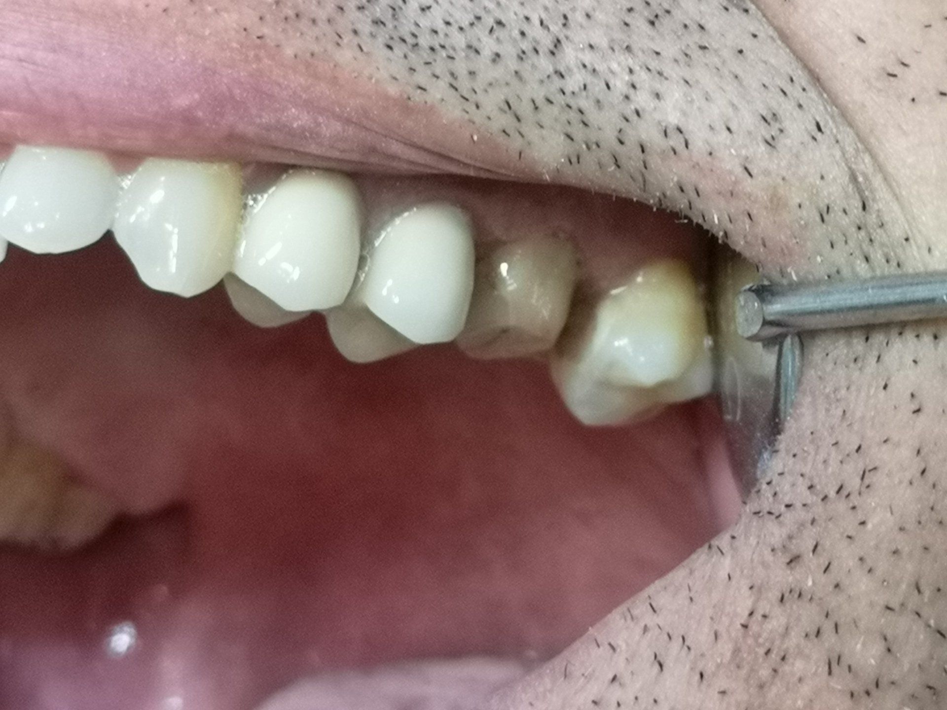 Primo piano della bocca di una persona, che mostra i denti e lo strumento odontoiatrico; un dente appare scolorito.
