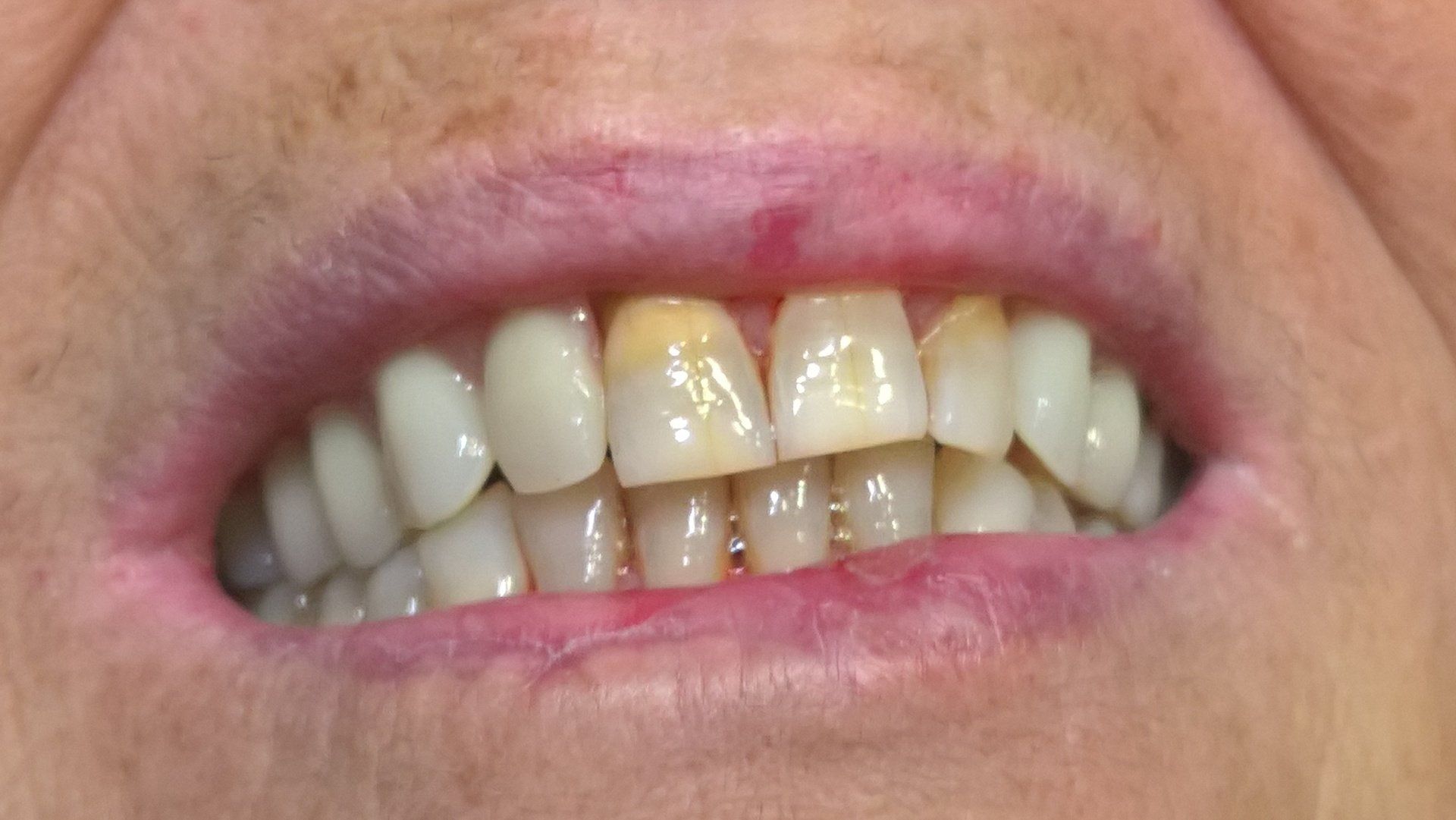 Arcata dentale corretta con protesi mobile