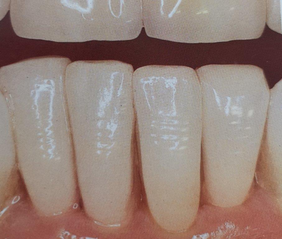 Primo piano di quattro denti anteriori con leggere creste verticali sul terzo dente. I denti sono bianchi e perlacei.