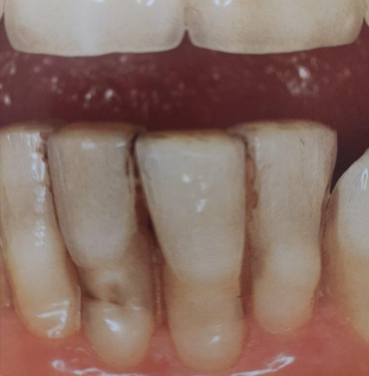 Primo piano dei denti. Alcuni denti appaiono scoloriti, mostrando segni di possibile carie.