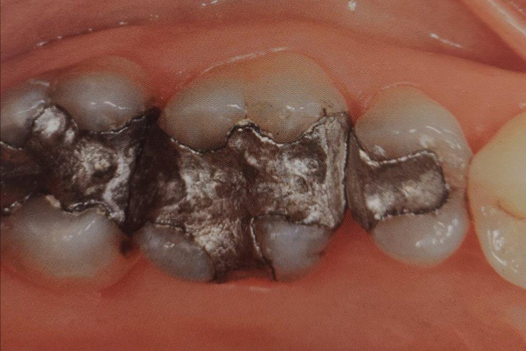 Primo piano di denti con diverse otturazioni metalliche scure.